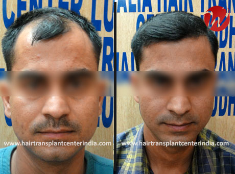 Hair Transplant In Chandigarh - Hair Transplant Around Chandigarh