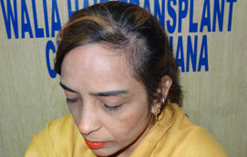 Female Hair Transplant