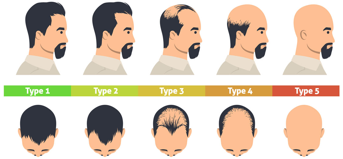 Male Pattern Baldness - Causes, Identification, and Prevention
