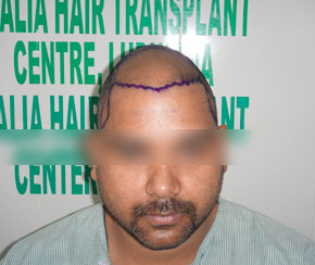 hair-transplant-before-after-img1