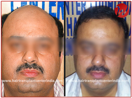 Hair Transplant in Ludhiana, Hair Transplant Cost In Ludhiana